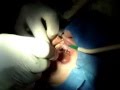 Implantes-Valussi