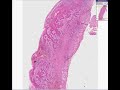 Histopathology Tongue - - Squamous cell carcinoma