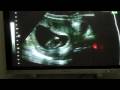 Our Baby: 14 week 3 days Ultrasound