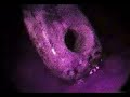 video-endoscopy-of-severe-gastritis.html