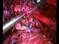 Endo Treatment - Radical Excision of Endometriosis