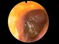 Acute Otitis media, tympanic blister