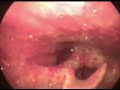 laryngeal tuberculosis