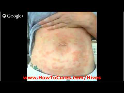 how to cure aquagenic urticaria