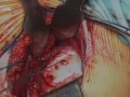 Movie 10 Glenoid suture