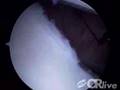 Bankart Repair To Correct Shoulder Instability