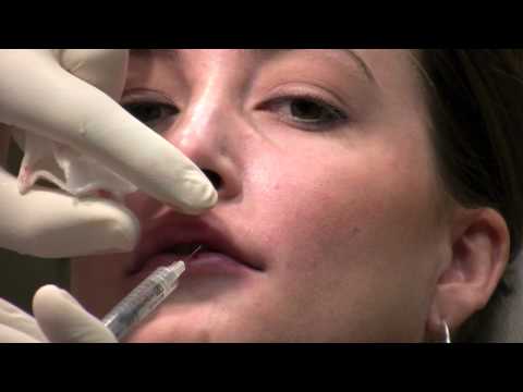 how to dissolve lip filler