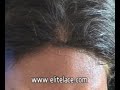 Full lace Wig Spirit Gum Removal