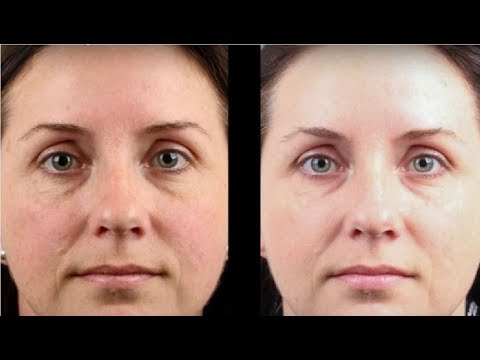 video-linktoworks-how to get rid of freckles fast and permanently