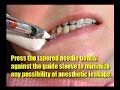 Root Tip #6 - Inferior Nerve Block - Part 2.wmv