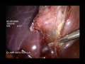 Acute cholecystitis morbid obese patient
