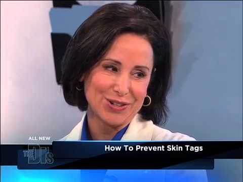 how to prevent skin tags