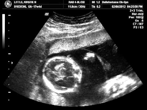 how to know twins gender