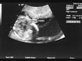 Prenatal Merrianna Jean Dahlin