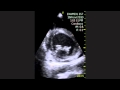 Dilated Cardiomyopathy