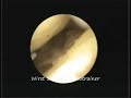 Wirst Surgery