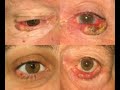 Enxerto Tarso Conjuntival para reparação de grandes defeitos palpebrais Enxerto Tarso Conjuntival para reparação de grandes defeitos palpebrais
