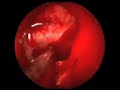 Craniopharyngioma Craniopharyngioma