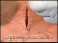 surgery continous interlocking suturing JOMAR MARCELO medici