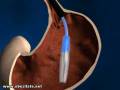 Balonul intragastric - extragerea
