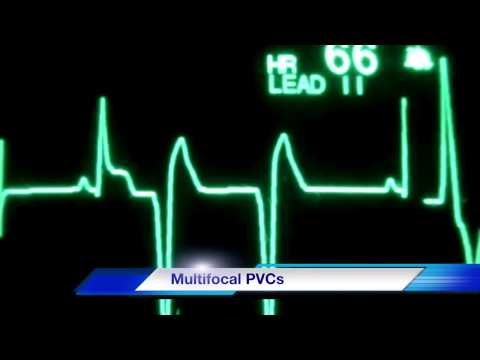 how to treat asystole