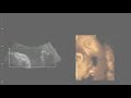 3D Ultrasound Picture Montage 29 Weeks 3 Days Pregnant