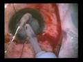 catarata y uveitis Dr Couto
