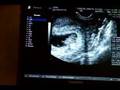 Baby ultrasound at 8 weeks