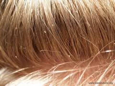 how to get rid lice at home