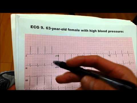 how to measure bleed in ct scan