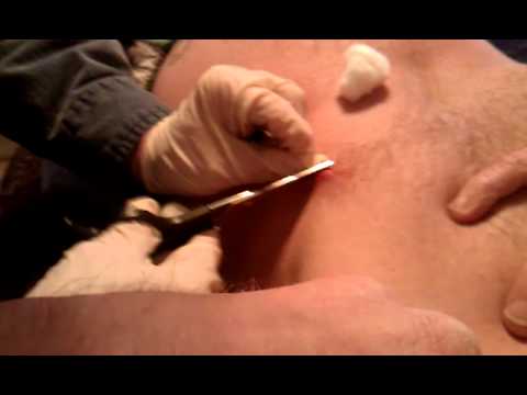 how to remove nipple ring