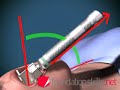 Endotracheal Ventilation Endotracheal Ventilation