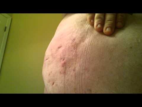 how to drain hidradenitis suppurativa