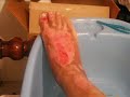 Second degree burn Second degree burn
