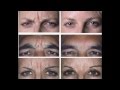 Click to View : Arrugas de Expresion (botox) Dr Jose MarÃa Jiménez