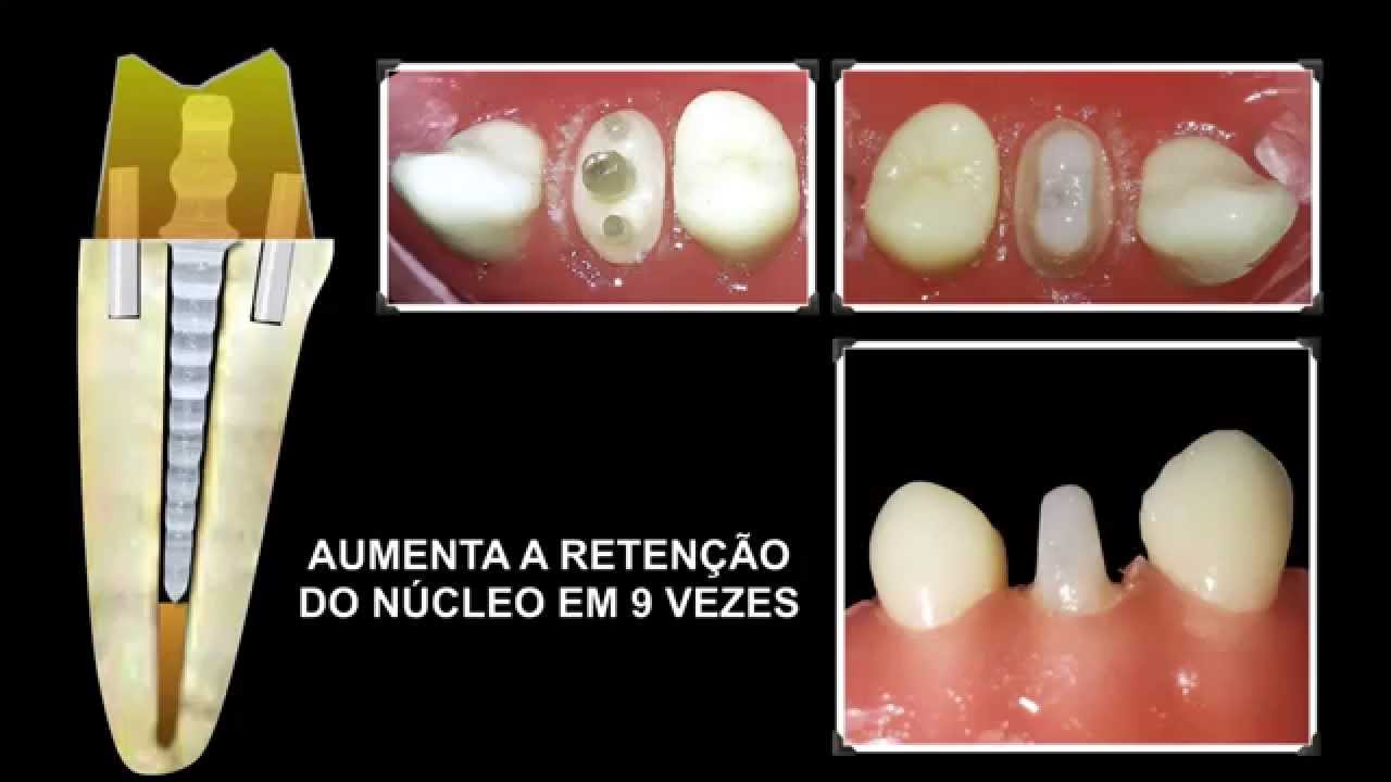 Núcleos estéticos dentais sem remanescente de coroa é possível?