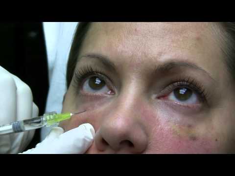 how to dissolve belotero