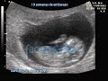10 Semanas de embarazo