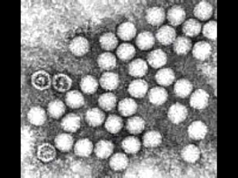 how to treat coxsackie b virus
