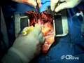 Heart Transplant Procedure From Montefiore-Einstein, NYC