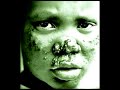 Leprosy