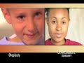 Otoplasty at Utah Cosmetic Surgery