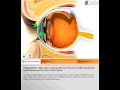 Astigmatism 3D: Quantel Medical