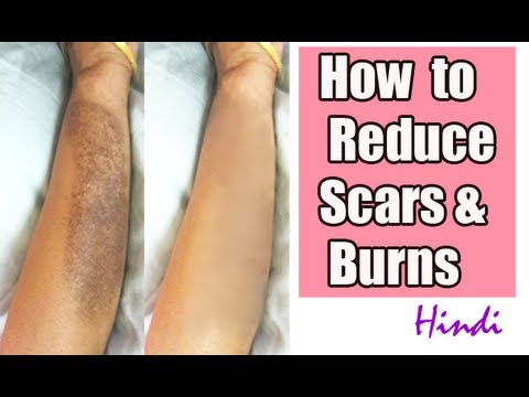 how to treat snake burns