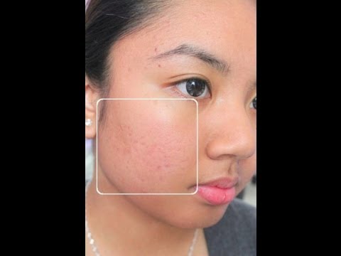 how to get rid of acne with home remedies