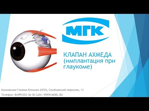 Видео Клапан Ахмеда при глаукоме