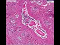 Histopathology Pancreas -- Cystic fibrosis