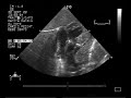 echocardiogram:transposition of the great arteries1/2 vsd asd pda.