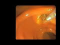 Fistulotomia Fistulotomia