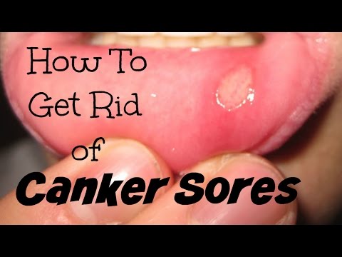 how to relieve the pain of a canker sore